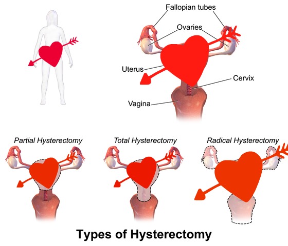 Why Having a Hysterectomy Was the Best Thing to Ever Happen to Me